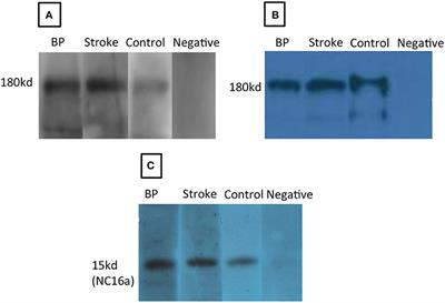 Anti-BP180 Autoantibodies Are Present in Stroke and Recognize Human Cutaneous BP180 and BP180-NC16A